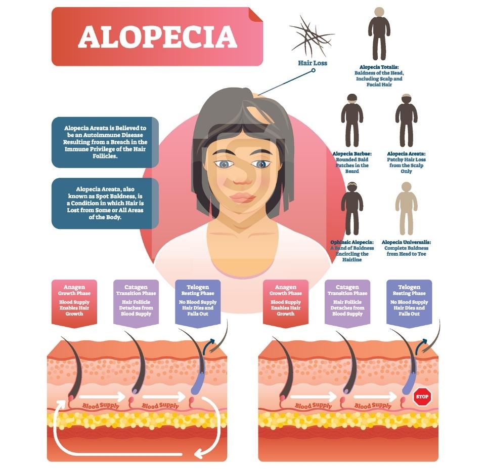 alopecia-infographic