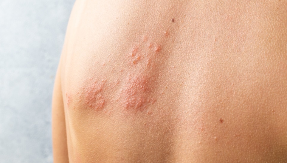 back of a person having shingles