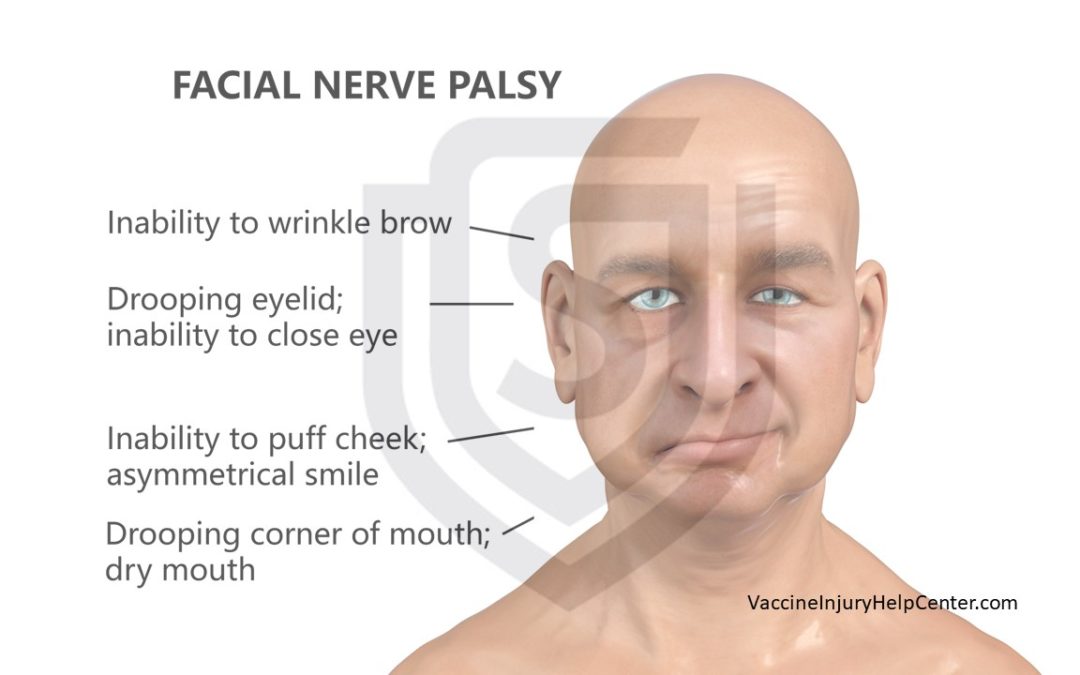 Bell’s Palsy and Vaccines