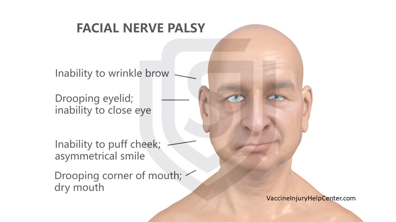 bells palsy vaccine