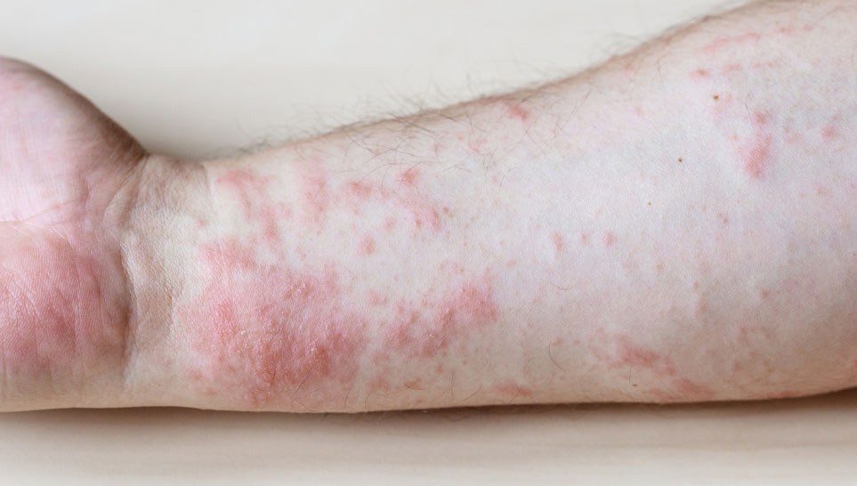itchy rashes cause by vaccine