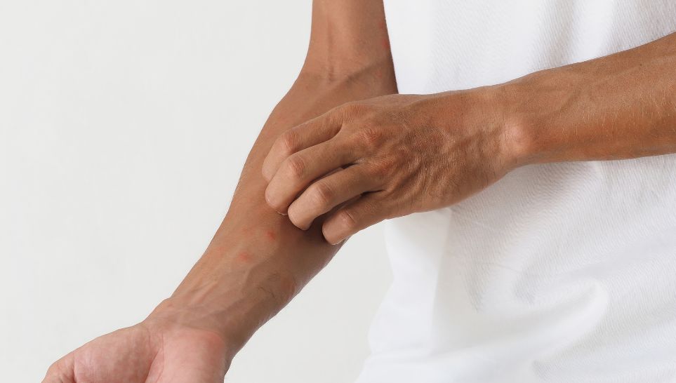 skin rashes caused by allergic reaction on male arms
